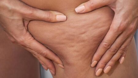 Cildiniz portakal kabuğu görünümündeyse dikkat! Selülit değil, lipödem olabilir