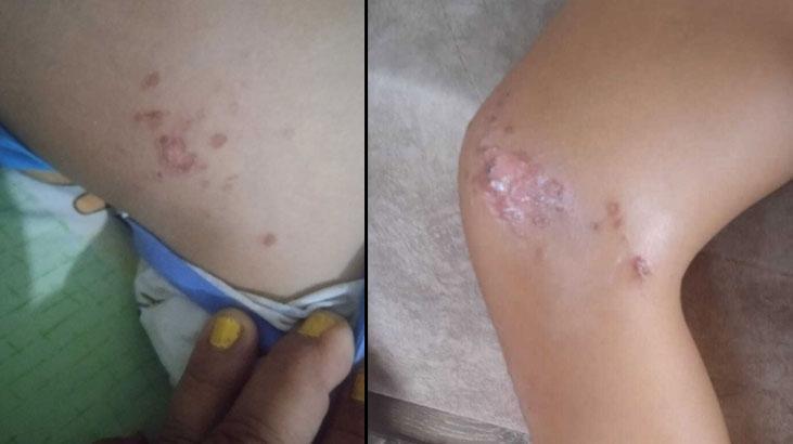 9 yaşındaki çocuk denizden çıktıktan sonra fenalaştı! Bedeninde çıkan lekelerle ilgili müthiş kuşku