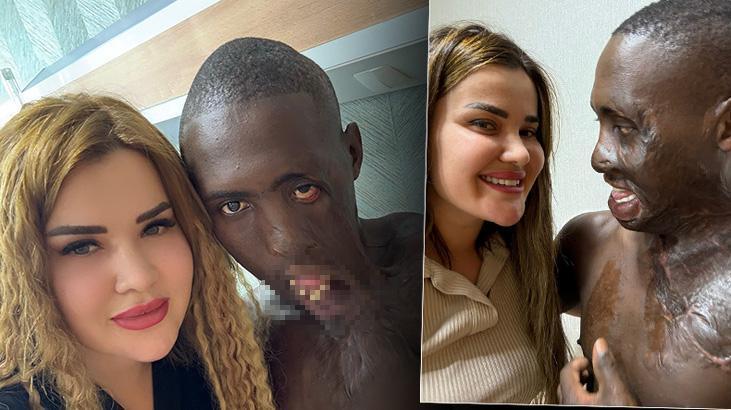 Dudağı omzuna yapışık halde Türkiye’ye geldi! Değişimi dünyaya umut oldu