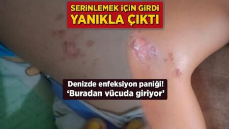 Serinlemek için girdi, yanıkla çıktı! Denizde enfeksiyon paniği: ‘Buradan bedene giriyor’